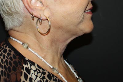 Neck Lift Before & After Gallery - Patient 148099876 - Image 4