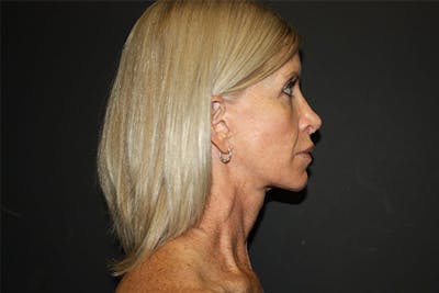 Facelift Before & After Gallery - Patient 5794650 - Image 1