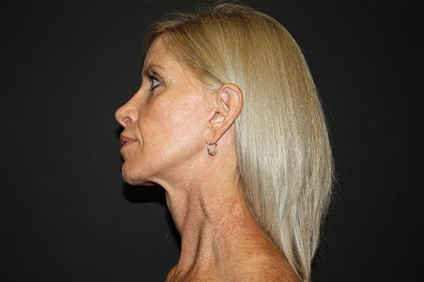 Facelift Before & After Gallery - Patient 5794650 - Image 3