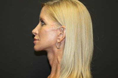 Facelift Before & After Gallery - Patient 5794650 - Image 4