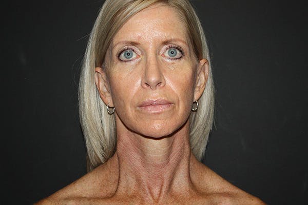 Facelift Before & After Gallery - Patient 5794650 - Image 5