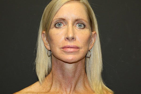 Facelift Before & After Gallery - Patient 5794650 - Image 6
