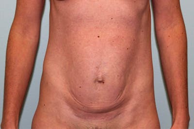 Tummy Tuck (Abdominoplasty) Before & After Gallery - Patient 5794627 - Image 1