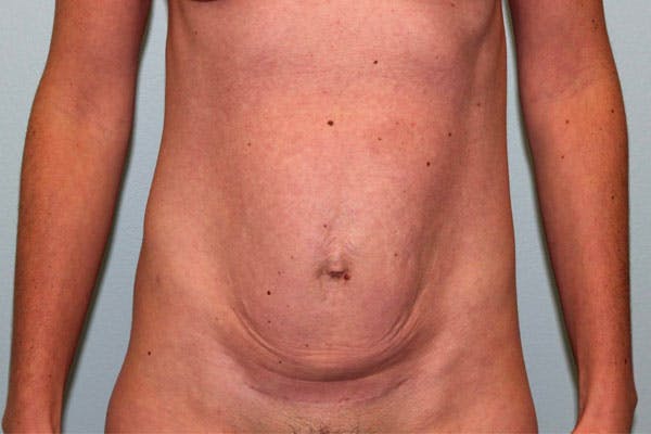 Tummy Tuck (Abdominoplasty) Before & After Gallery - Patient 5794627 - Image 1