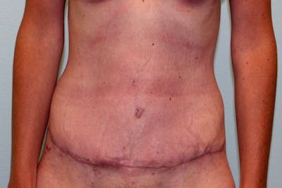 Tummy Tuck (Abdominoplasty) Before & After Gallery - Patient 5794627 - Image 2