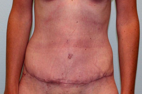 Tummy Tuck (Abdominoplasty) Before & After Gallery - Patient 5794627 - Image 2
