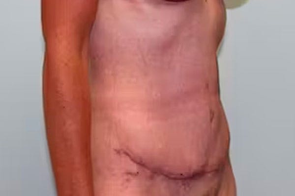 Tummy Tuck (Abdominoplasty) Before & After Gallery - Patient 5794627 - Image 4