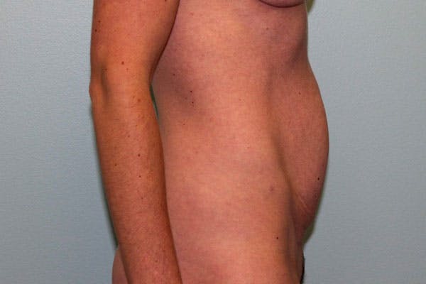 Tummy Tuck (Abdominoplasty) Before & After Gallery - Patient 5794627 - Image 5