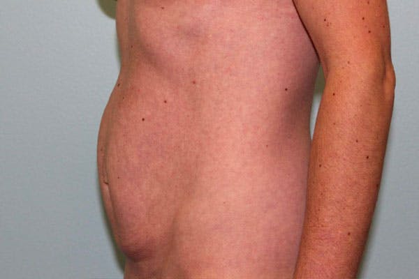 Tummy Tuck (Abdominoplasty) Before & After Gallery - Patient 5794627 - Image 7