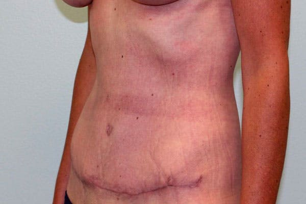 Tummy Tuck (Abdominoplasty) Before & After Gallery - Patient 5794627 - Image 8