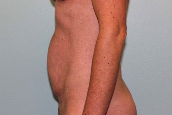Tummy Tuck (Abdominoplasty) Before & After Gallery - Patient 5794627 - Image 9