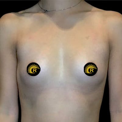 Breast Augmentation Before & After Gallery - Patient 146691978 - Image 1