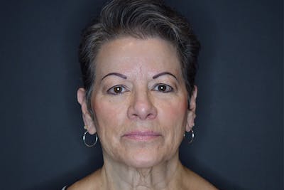 Facelift Before & After Gallery - Patient 173727697 - Image 1