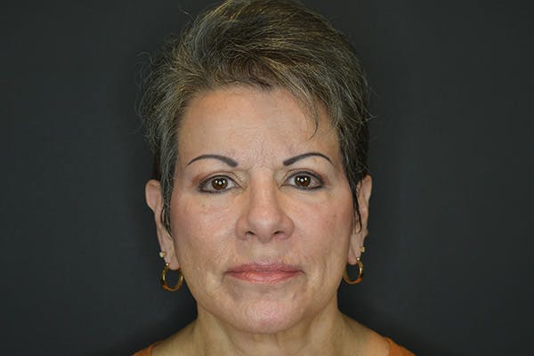 Regency Lift Before & After Gallery - Patient 173727697 - Image 2