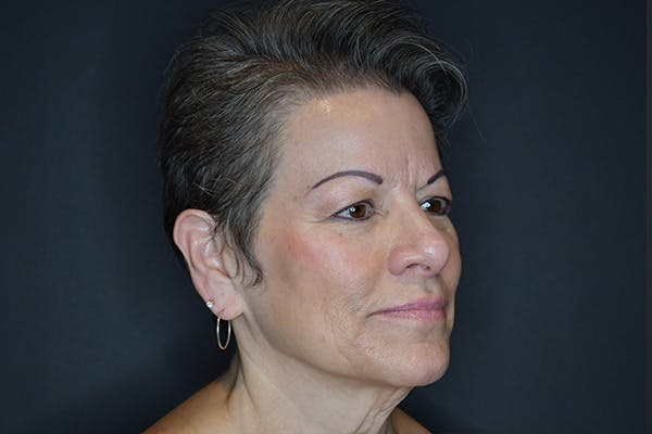 Facelift Before & After Gallery - Patient 173727697 - Image 3