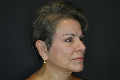 Neck Lift Before & After Gallery - Patient 174195499 - Image 4