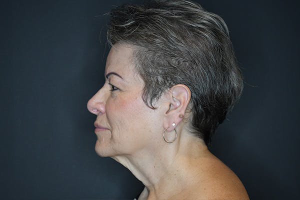Facelift Before & After Gallery - Patient 173727697 - Image 5