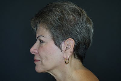 Facelift Before & After Gallery - Patient 173727697 - Image 6