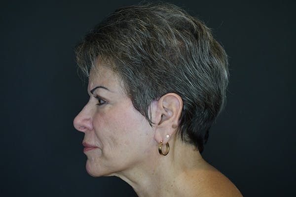 Neck Lift Before & After Gallery - Patient 174195499 - Image 2