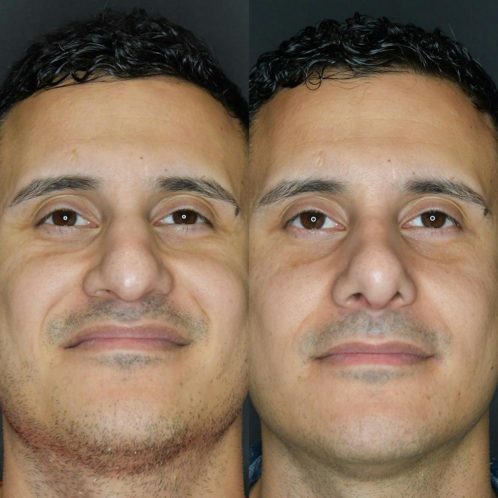 Rhinoplasty Before & After Gallery - Patient 174095061 - Image 6