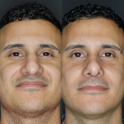 Rhinoplasty Before & After Gallery - Patient 174095061 - Image 6