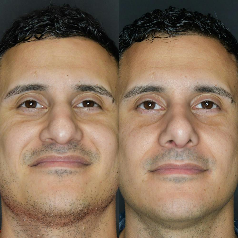 Rhinoplasty Before & After Gallery - Patient 174094478 - Image 3