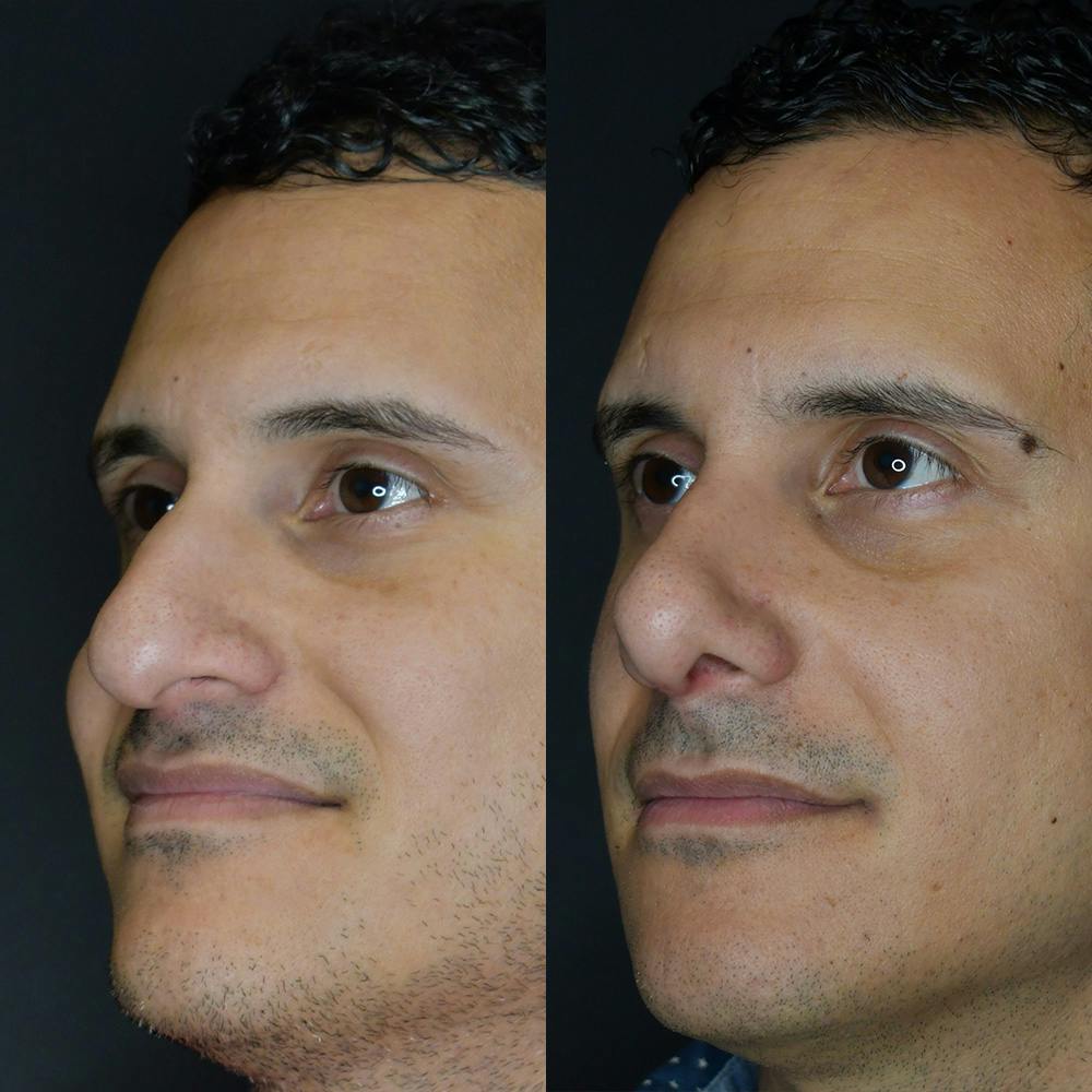 Rhinoplasty Before & After Gallery - Patient 174094478 - Image 1