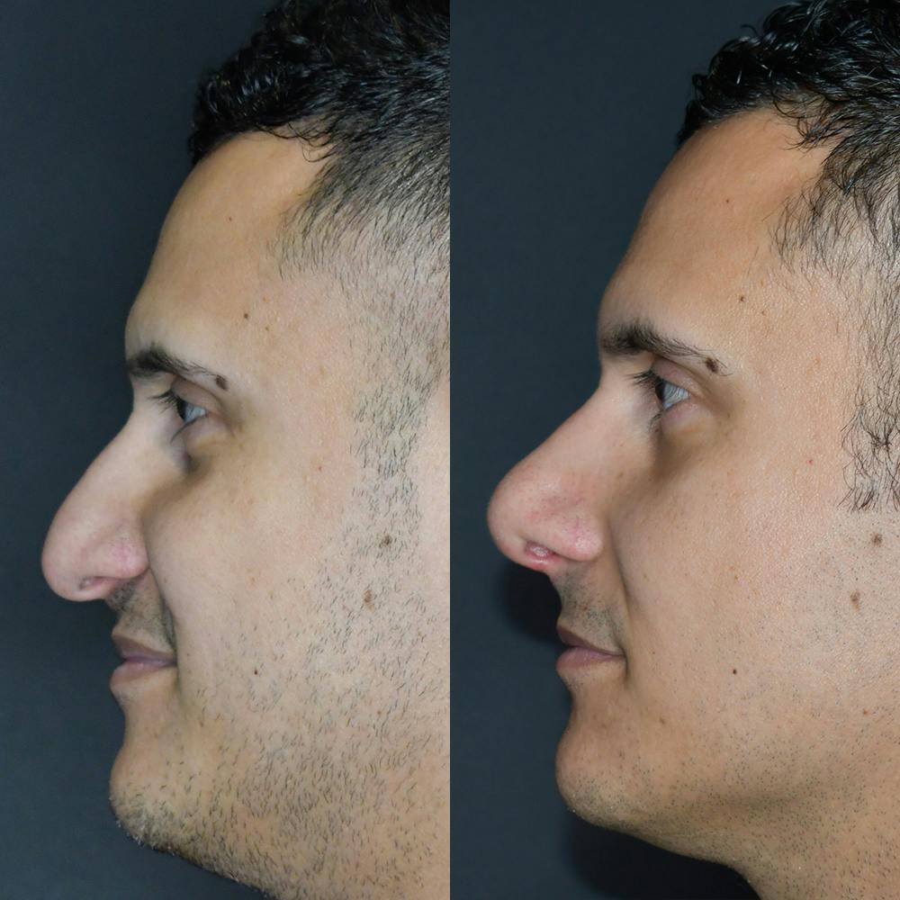 Rhinoplasty Before & After Gallery - Patient 174094478 - Image 2