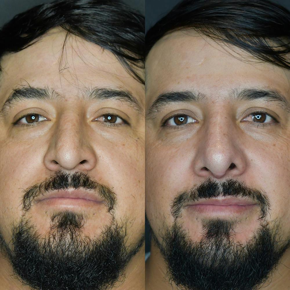 Rhinoplasty Before & After Gallery - Patient 174095061 - Image 3
