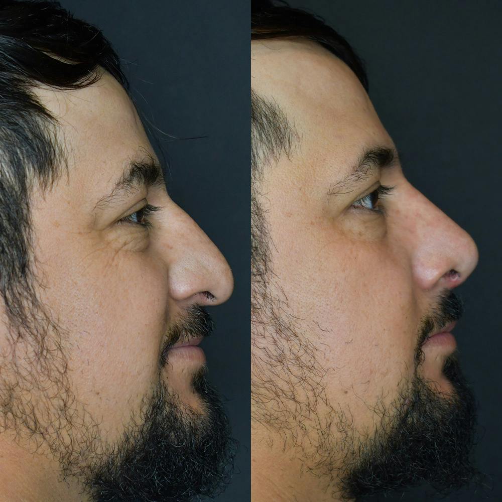 Rhinoplasty Before & After Gallery - Patient 174095061 - Image 1