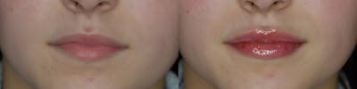 Lip Filler Before & After Gallery - Patient 174196025 - Image 1