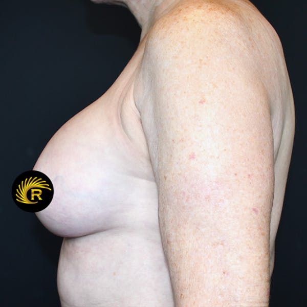 Breast Augmentation Before & After Gallery - Patient 185643445 - Image 4