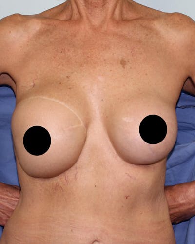 Breast Reconstruction Before & After Gallery - Patient 5799696 - Image 1