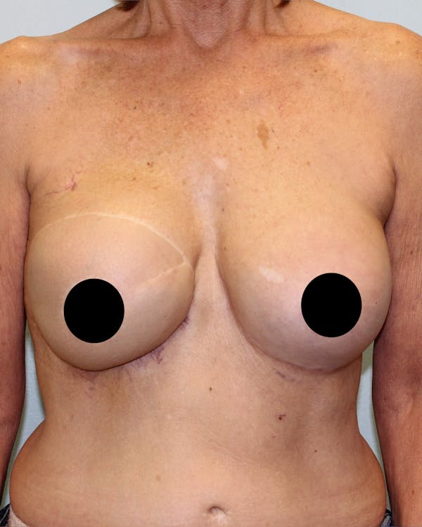 Breast Reconstruction Before & After Gallery - Patient 5799696 - Image 2