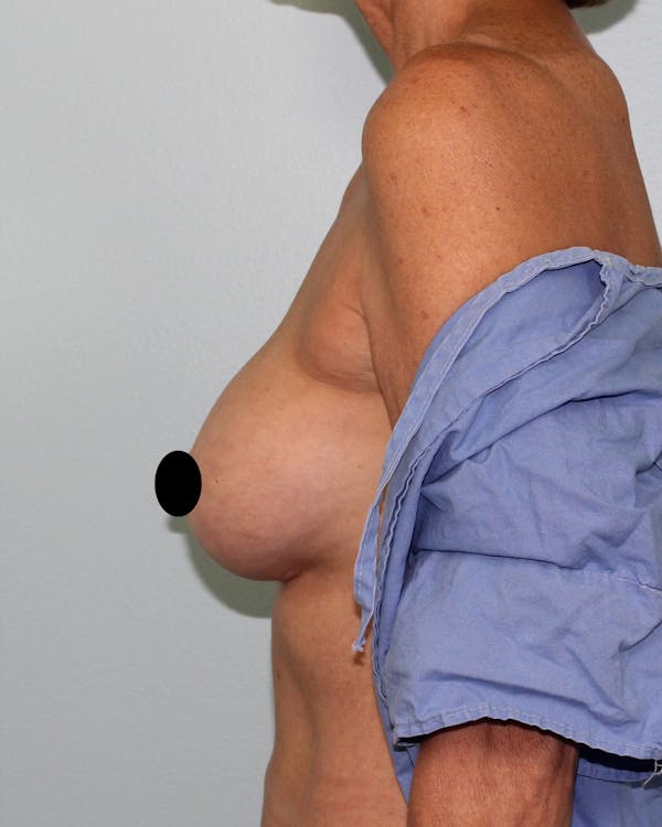 Breast Reconstruction Before & After Gallery - Patient 5799696 - Image 3
