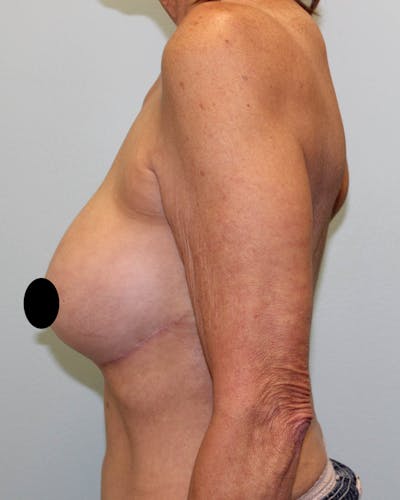 Breast Reconstruction Before & After Gallery - Patient 5799696 - Image 4