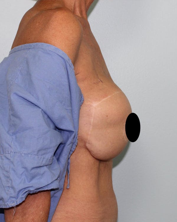 Breast Reconstruction Before & After Gallery - Patient 5799696 - Image 5