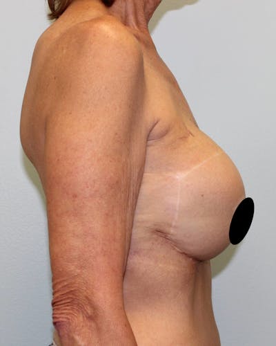 Breast Reconstruction Before & After Gallery - Patient 5799696 - Image 6