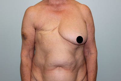 Breast Reconstruction Before & After Gallery - Patient 5799715 - Image 1