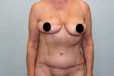 Breast Reconstruction Before & After Gallery - Patient 5799715 - Image 2