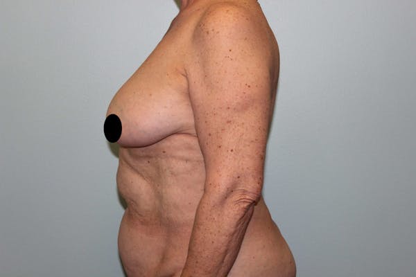 Breast Reconstruction Before & After Gallery - Patient 5799715 - Image 9