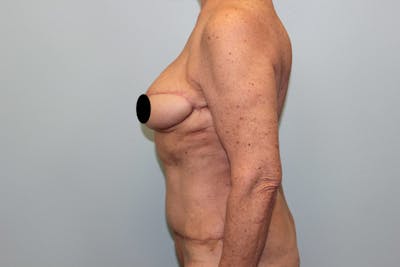 Breast Reconstruction Before & After Gallery - Patient 5799715 - Image 10