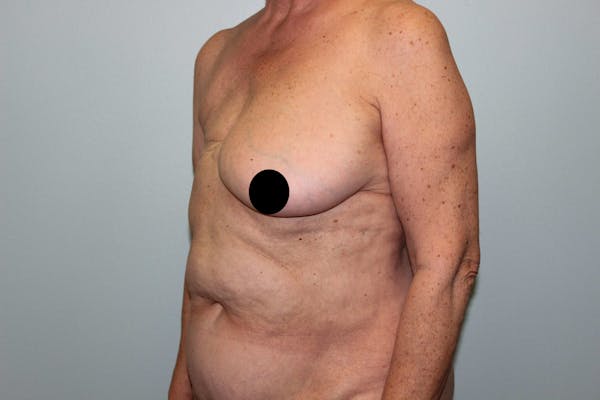 Breast Reconstruction Before & After Gallery - Patient 5799715 - Image 7