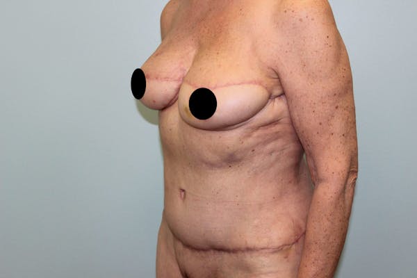 Breast Reconstruction Before & After Gallery - Patient 5799715 - Image 8