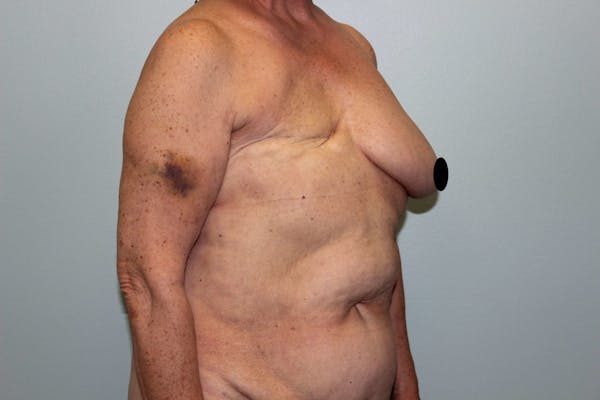 Breast Reconstruction Before & After Gallery - Patient 5799715 - Image 3