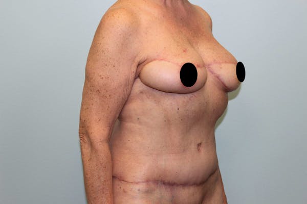 Breast Reconstruction Before & After Gallery - Patient 5799715 - Image 4