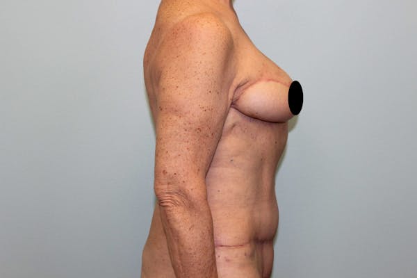 Breast Reconstruction Before & After Gallery - Patient 5799715 - Image 6