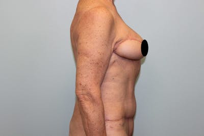 Breast Reconstruction Before & After Gallery - Patient 5799715 - Image 6