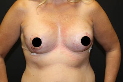 Breast Reconstruction Before & After Gallery - Patient 5799723 - Image 1