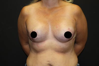 Breast Reconstruction Before & After Gallery - Patient 5799723 - Image 2